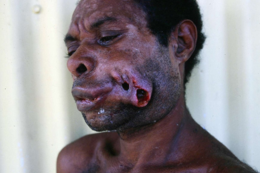 Close up of man with facial deformities resulting from oral cancer.