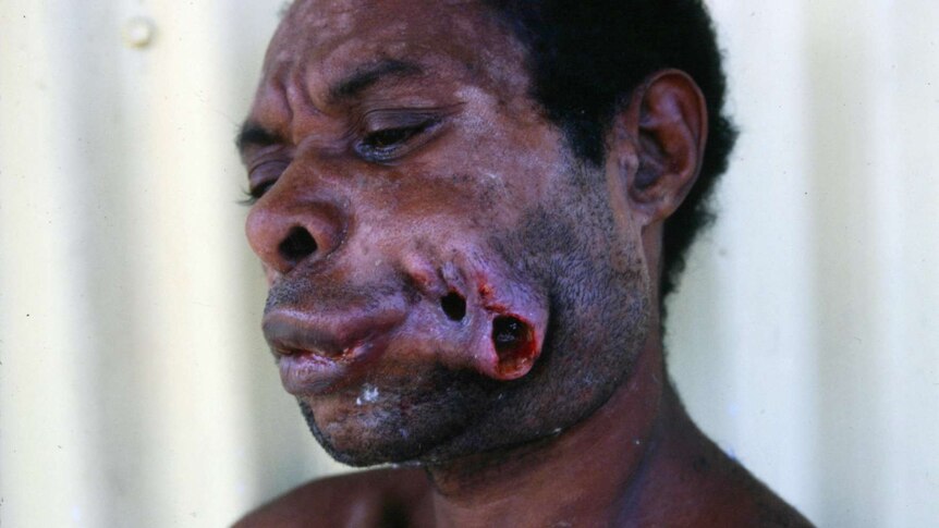 Close up of man with facial deformities resulting from oral cancer.