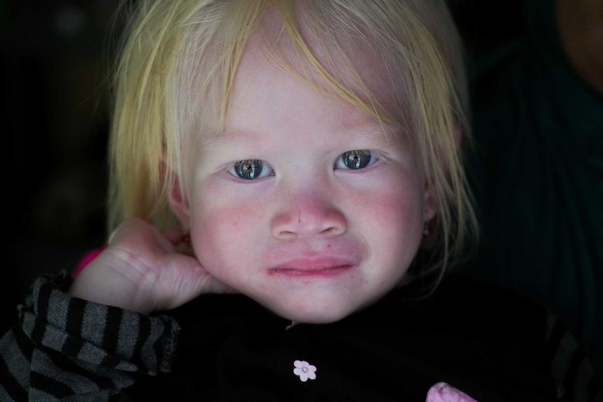 For a child to be albino both parents must carry a gene.