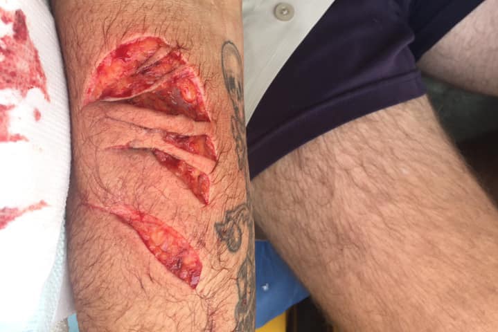 A graphic image of an arm that's been bitten by a shark.