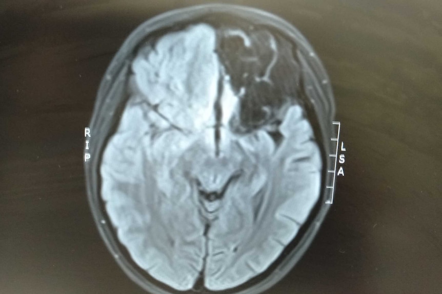 A MRI of Kaylah's brain which shows almost a quarter of dark, damaged matter.
