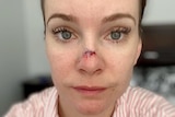 A selfie-style shot of a woman who has had surgery on the tip of her nose.