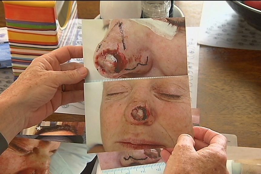 Photos of skin cancer patient Collene Bakewell-Hill's nose