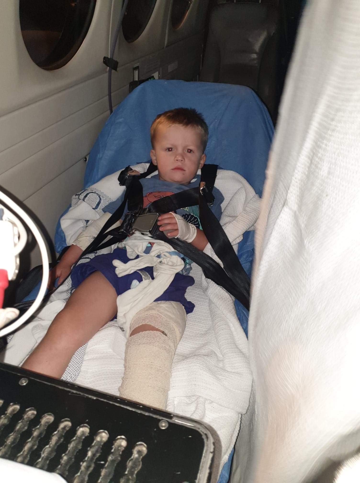 Outback Queensland family backs Royal Flying Doctor burns appeal after 4yo son fell into fire pit - Vimarsana News