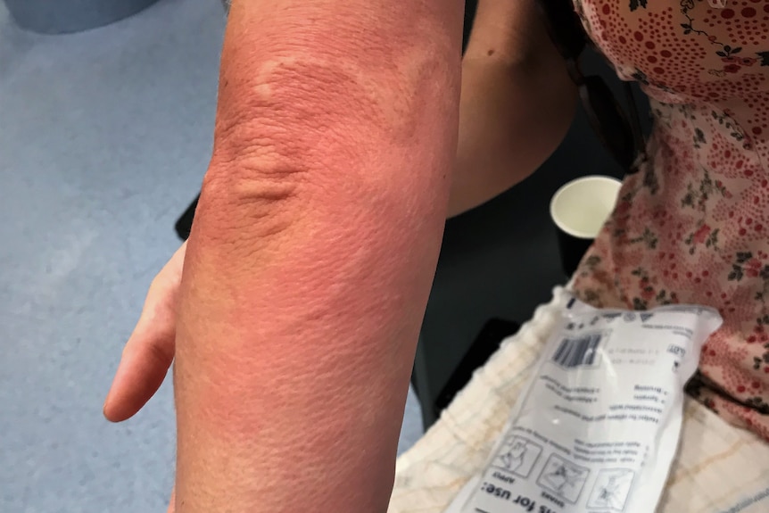 An arm covered in a bright red rash.