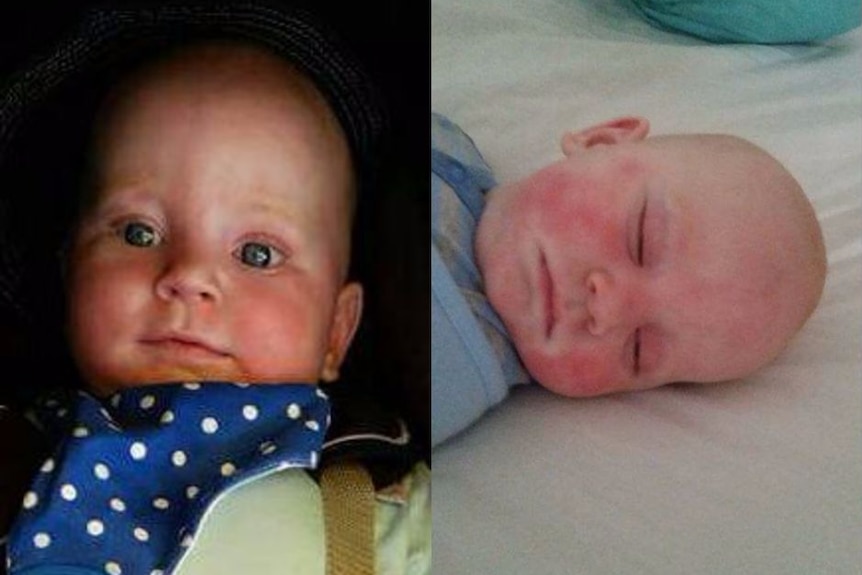 Baby has reaction to Cancer Council's kids sunscreen