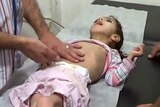 A malnourished Syrian child lies on a table in a clinic.