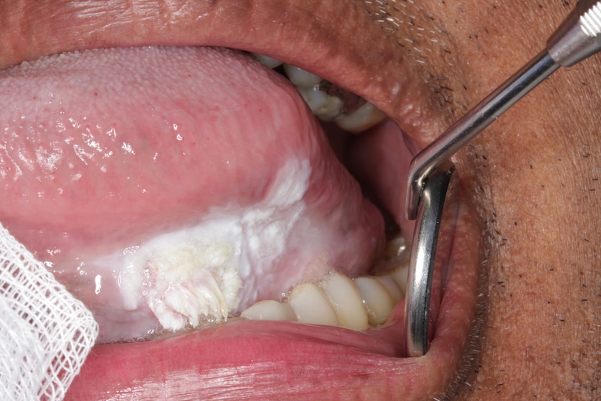 A close up medical shot of a lesion in a persons mouth, white tissue looks like a big ulcer