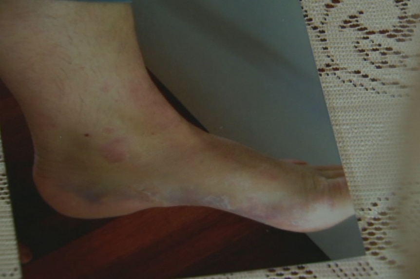 Yvonne Berry foot injury