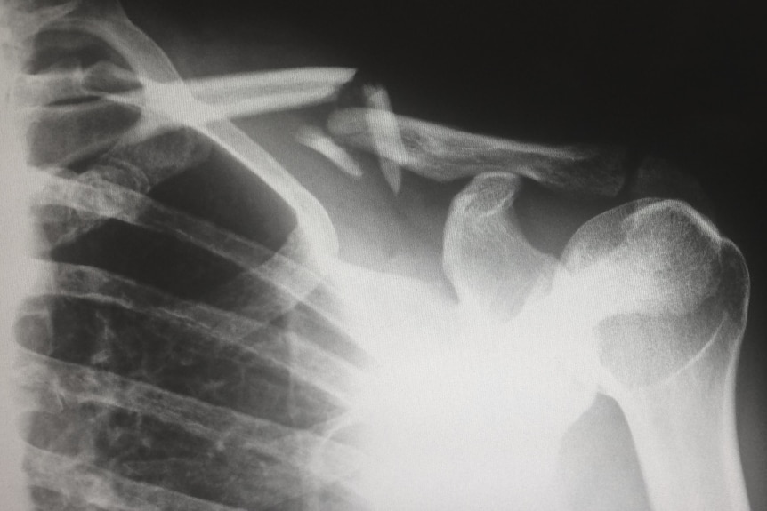 An x-ray with broken bones.