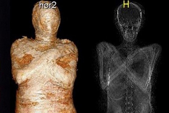 X-Ray images of the pregnant Egyptian mummy taken in 2015 at a medical centre in Otwock near Warsaw, Poland.