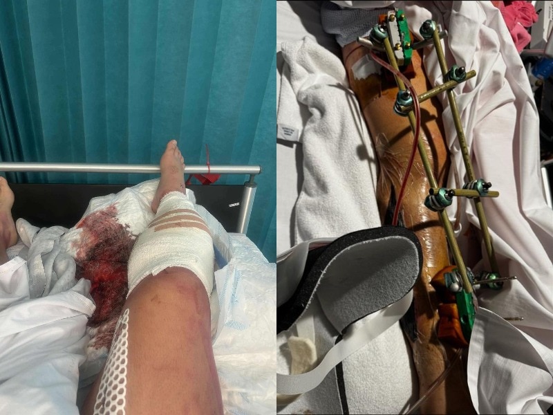 Uma imagem de uma perna machucada em uma cama de hospital