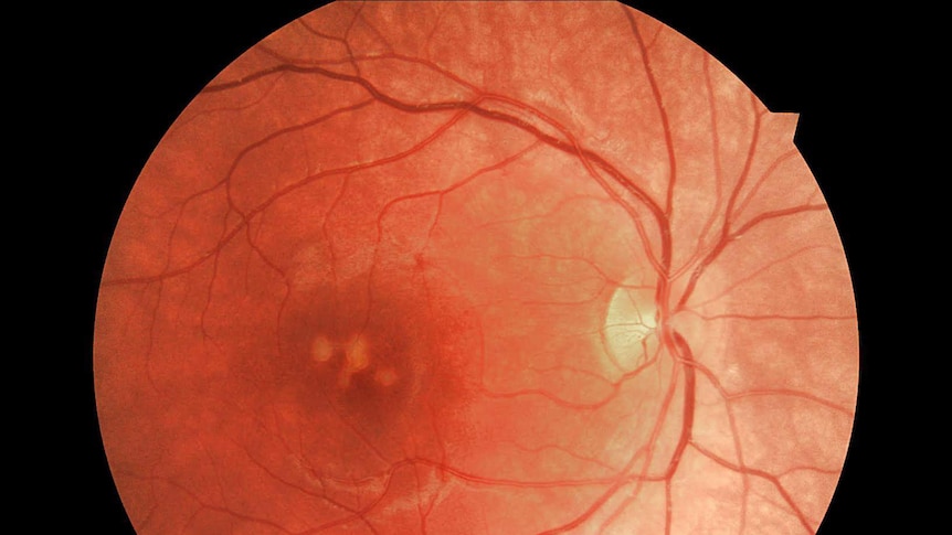 Permanent damage on teenager's retina