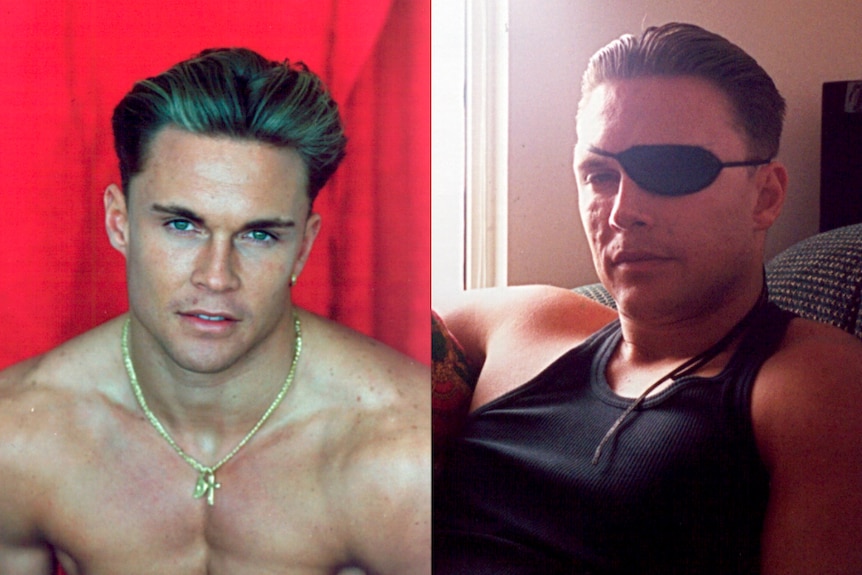 Before and after of Brett Boyd showing a modelling shot next to him after the blast with an eyepatch