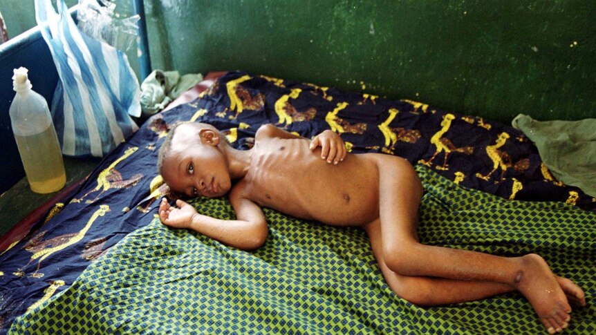 A malnourished child lays on their side naked on a bedsheets with bright patterns.