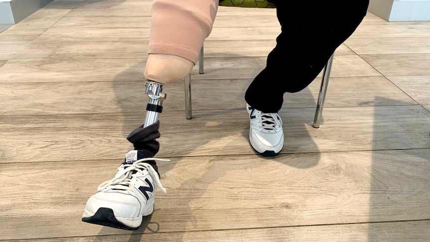 A prosthetic leg attached to a patient.