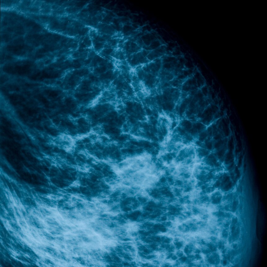 Mammogram x-ray image of breasts 
