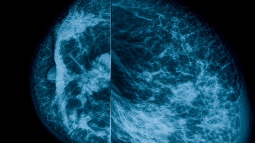 Mammogram x-ray image of breasts 