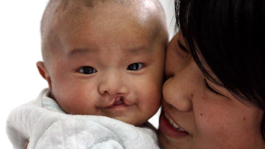 A chinese baby with cleft lip being held by his mother in Shanxi province, China