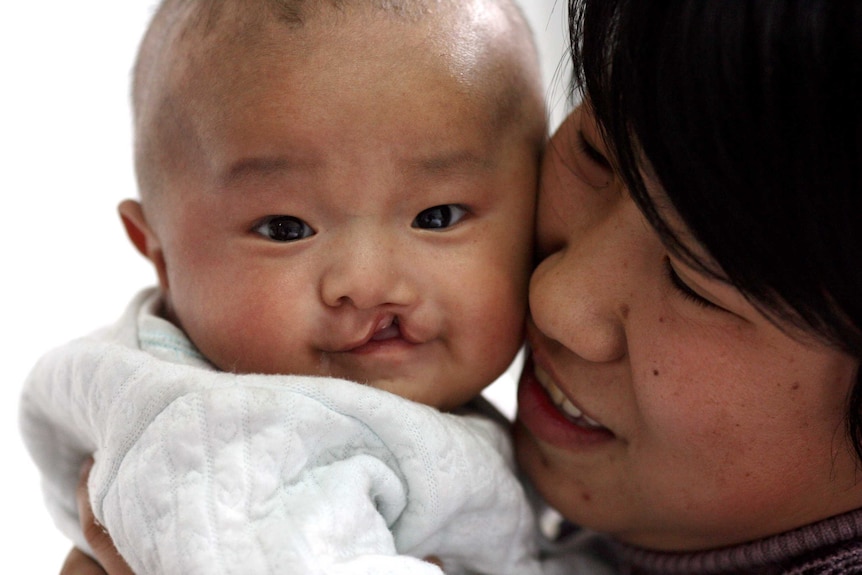 A chinese baby with cleft lip being held by his mother in Shanxi province, China