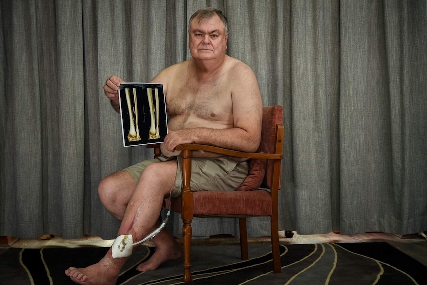 Brian Robert's poses for a photograph at home with no shirt on after suffering Compartment Syndrome from a motor bike accident .