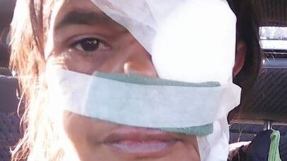 A woman has bandages over her eye and top of lip, covering her wounds