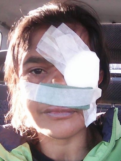 A woman has bandages over her eye and top of lip, covering her wounds