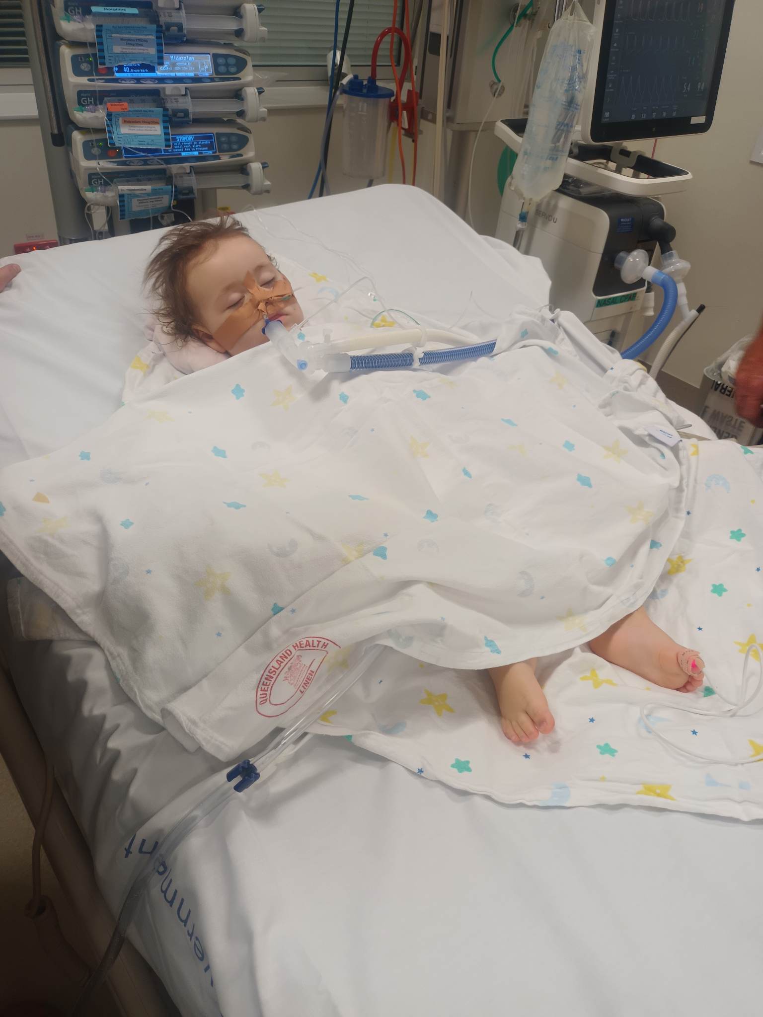 Little girl lies in hospital bed with feeding and breathing tube in her mouth. 