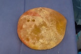 A breast implant infected with bacteria looks yellow.