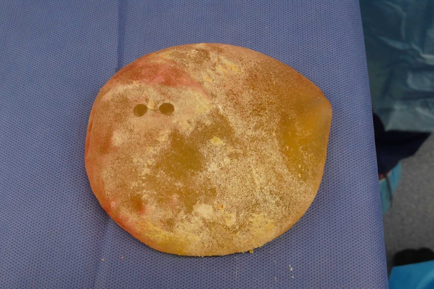 A breast implant infected with bacteria looks yellow.