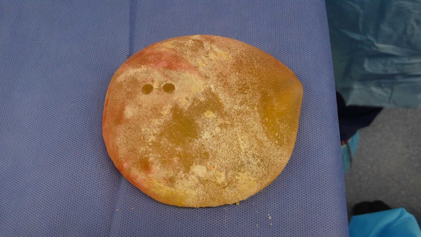 A breast implant infected with bacteria looks yellow.