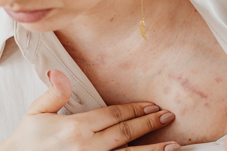 A woman holds her fingers to her collarbone where a long scar can be seen
