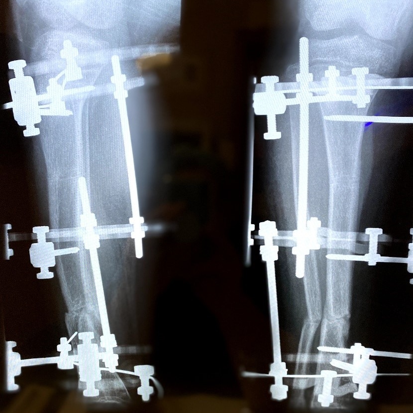 X ray of legs in a brace