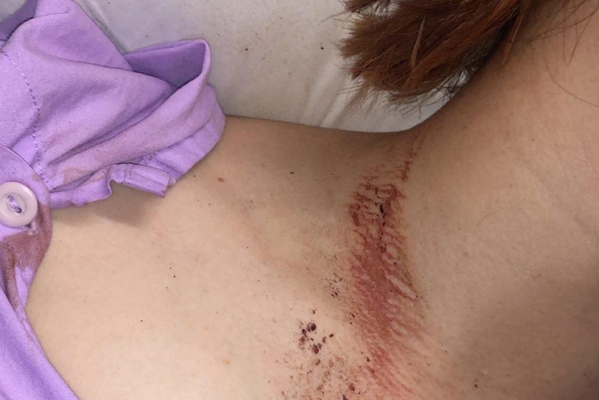A woman with burns to her neck from the seatbelt of her car.