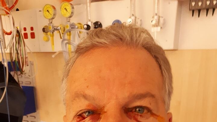 A man in a hospital bed with bloody injuries around his eyes.