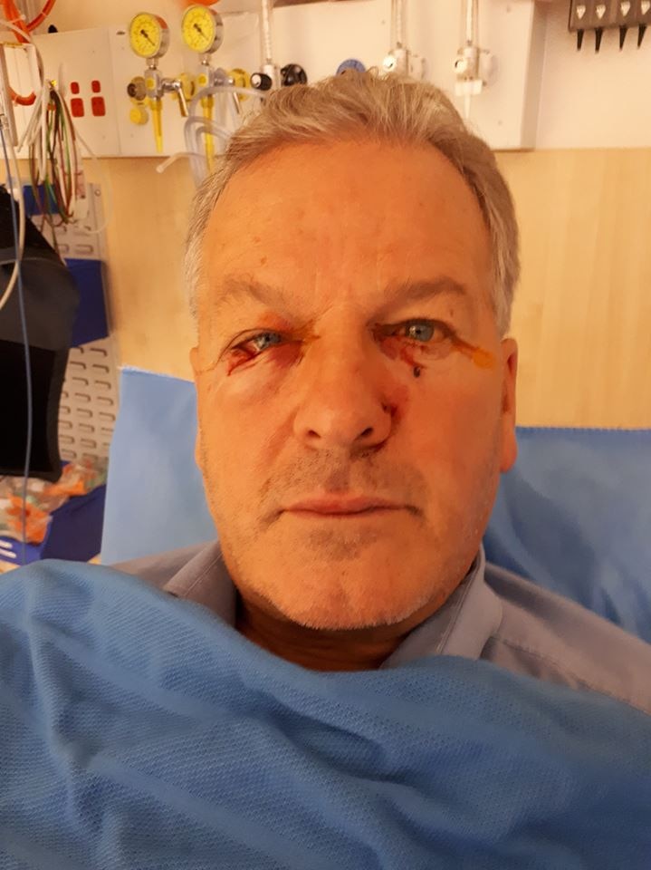 A man in a hospital bed with bloody injuries around his eyes.