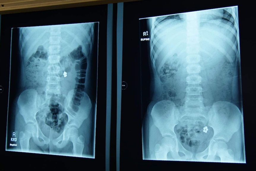 Two X-rays of seven-year-old Olivia Fay's torso, showing five magnetic balls she swallowed.