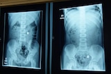Two X-rays of seven-year-old Olivia Fay's torso, showing five magnetic balls she swallowed.