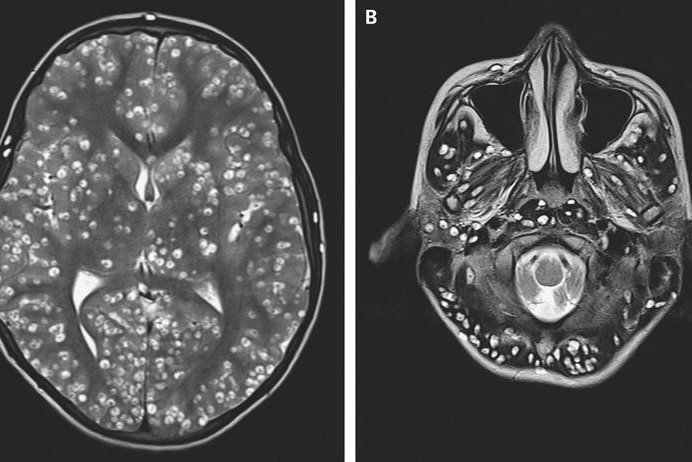 A black and white MRI scan showing white dots covering the brain