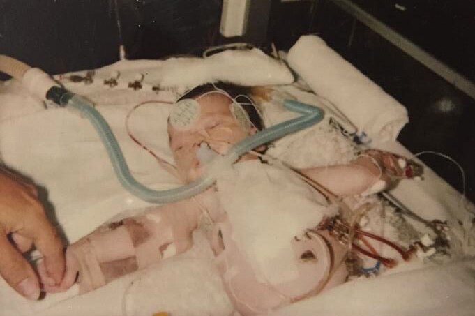 Erin Zilm as a baby after having open heart surgery