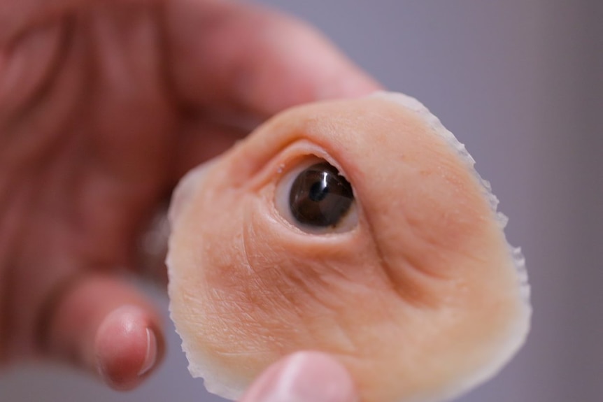 A close-up of an orbital prosthesis