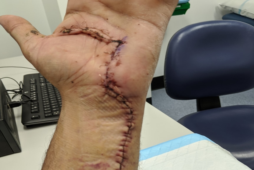 Karim's hand has a long scar extending up his arm, stitched together and still healing.