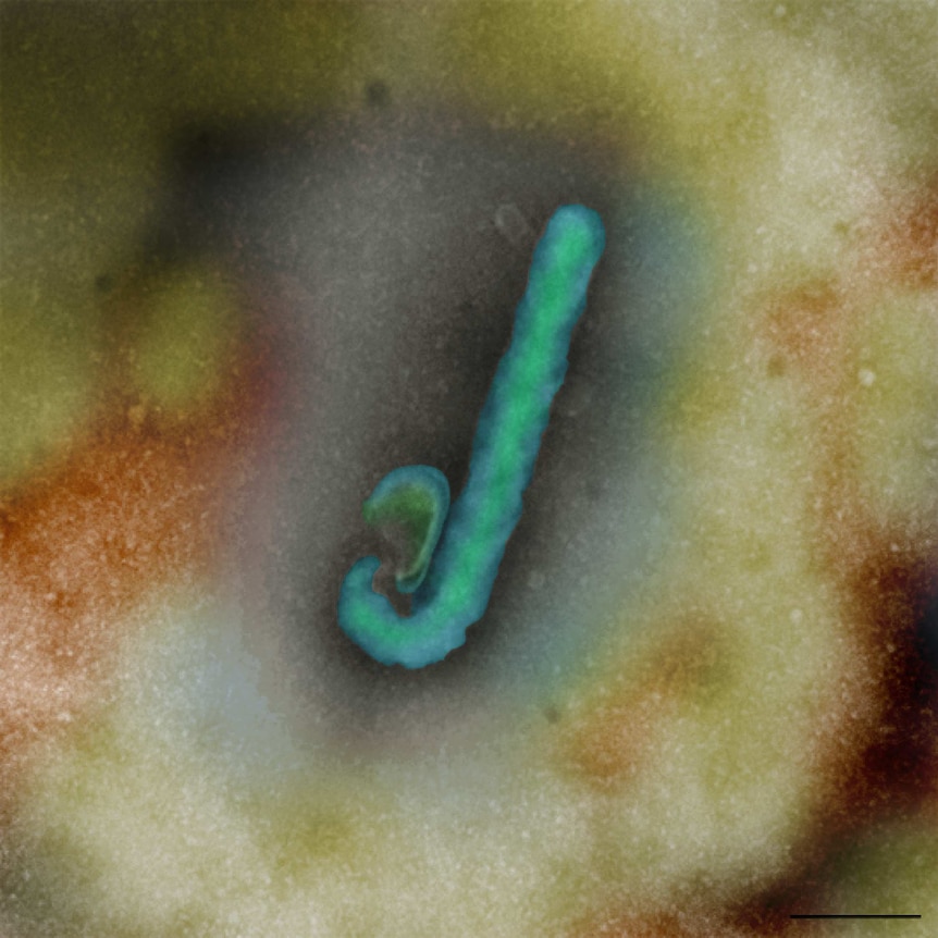 The Ebola virus causes diarrhoea and internal and external bleeding.