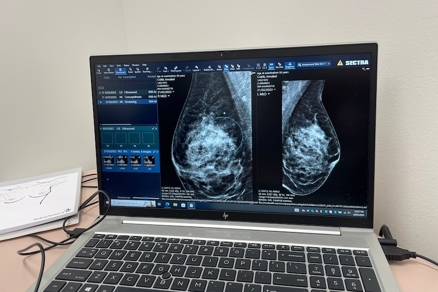 A silver laptop displaying images of 3D breast scans