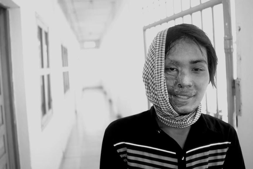 A victim of an acid attack, with affected skin on one side of her face, stand in a hallway smiling.
