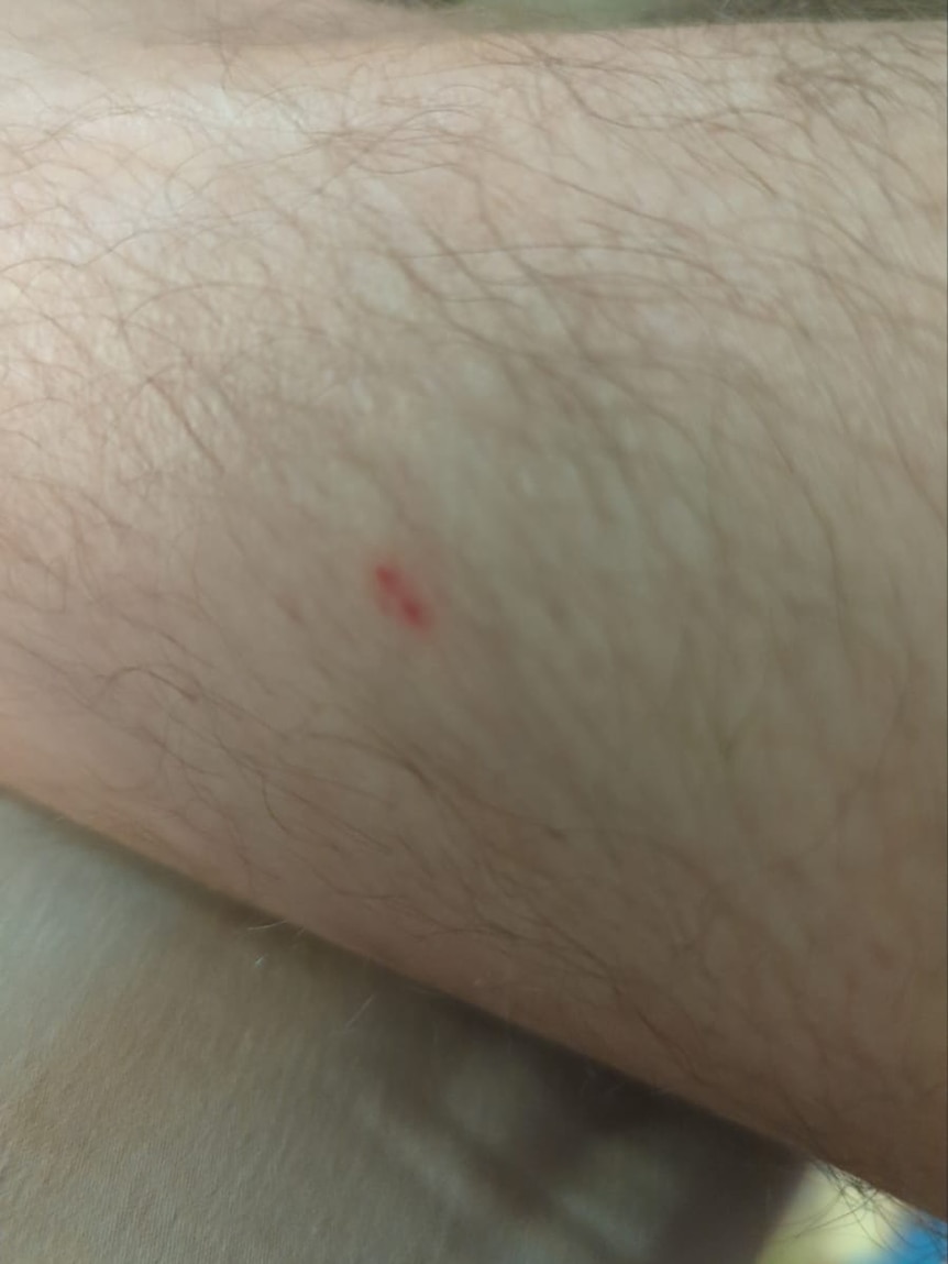 Close up of a hairy, white leg, with a small red fang bite.