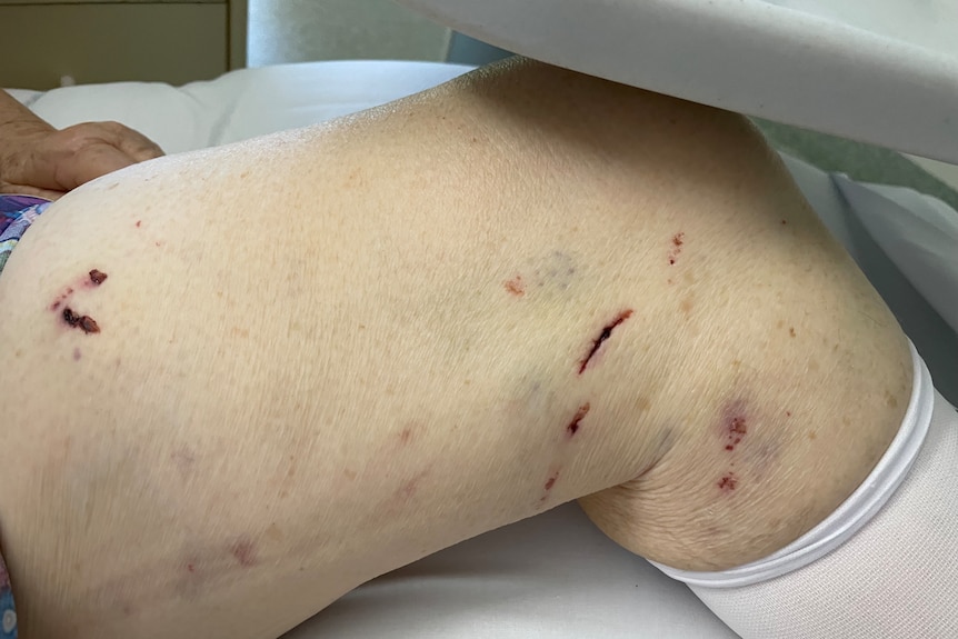 A picture of an older woman's scratched, bruised and swollen leg.