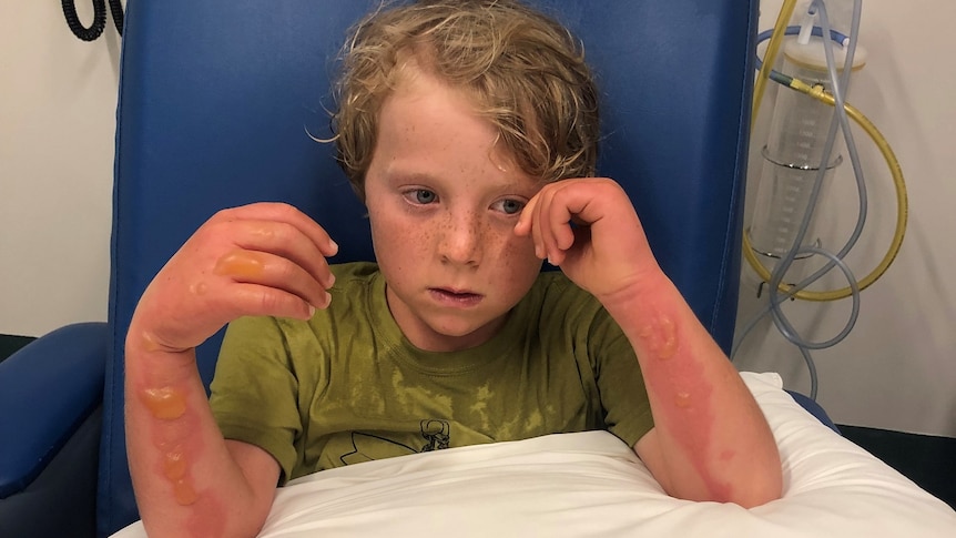 A small boy rests his arms on a pillow to display large and painful-looking blisters.