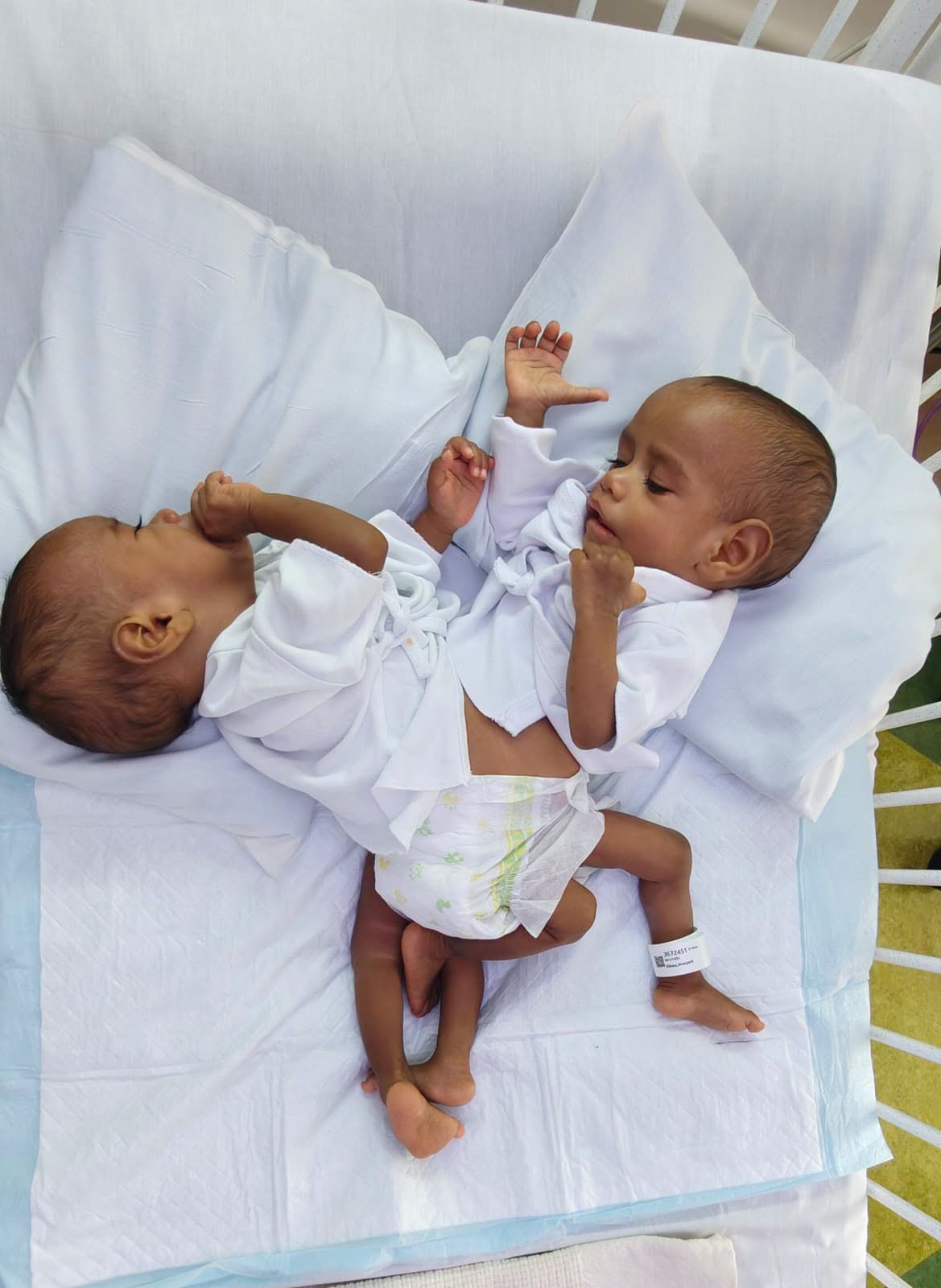 Complex surgery successfully separates Fijian conjoined twins