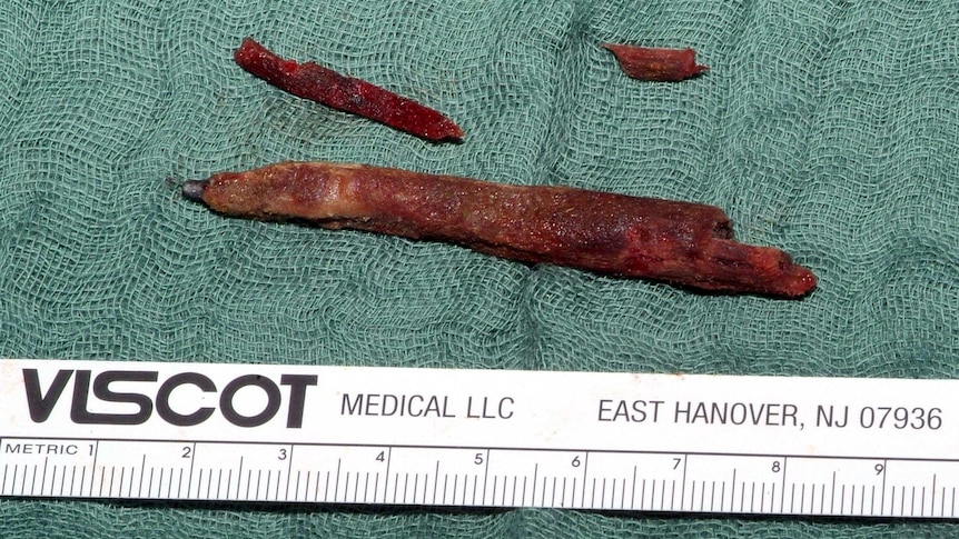 Pencil removed from head.